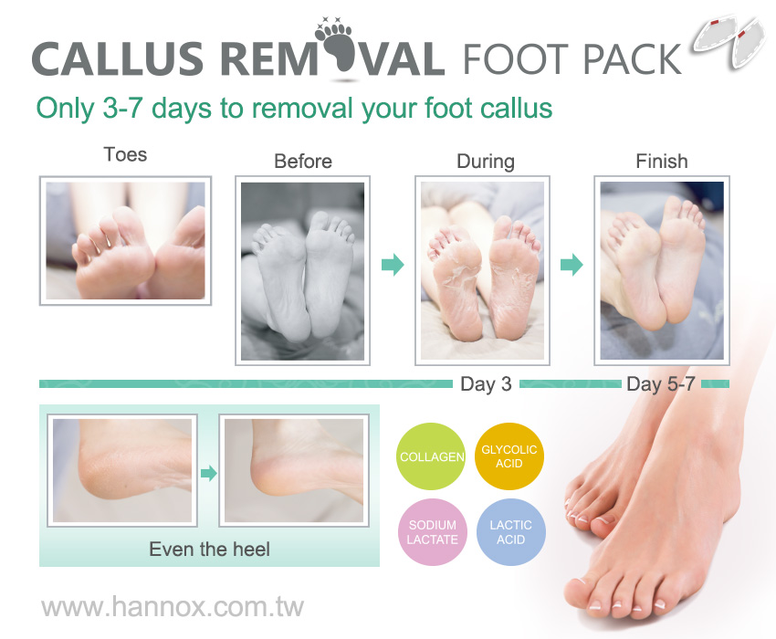 Callus Removal Foot Pack