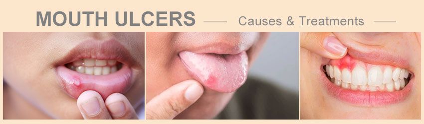 muoth ulcers